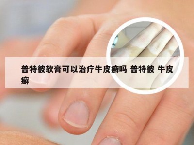 普特彼软膏可以治疗牛皮癣吗 普特彼 牛皮癣
