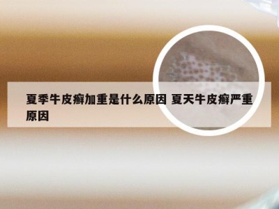 夏季牛皮癣加重是什么原因 夏天牛皮癣严重原因