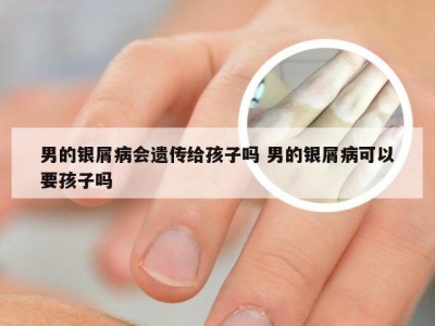 男的银屑病会遗传给孩子吗 男的银屑病可以要孩子吗