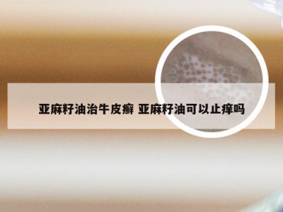 亚麻籽油治牛皮癣 亚麻籽油可以止痒吗