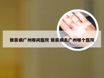 银屑病广州哪间医院 银屑病去广州哪个医院