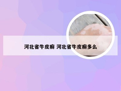 河北省牛皮癣 河北省牛皮癣多么