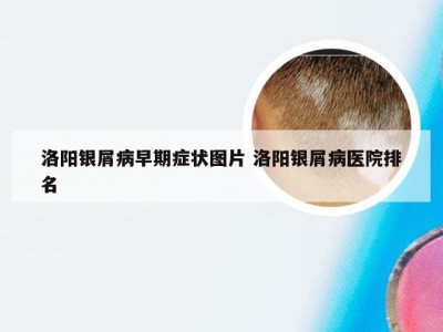 洛阳银屑病早期症状图片 洛阳银屑病医院排名