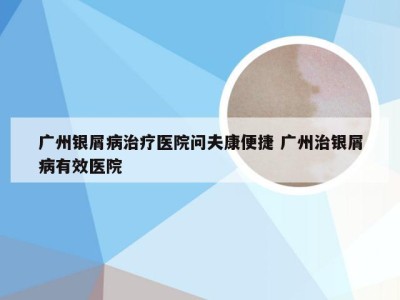 广州银屑病治疗医院问夫康便捷 广州治银屑病有效医院