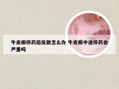 牛皮癣停药后反跳怎么办 牛皮癣中途停药会严重吗