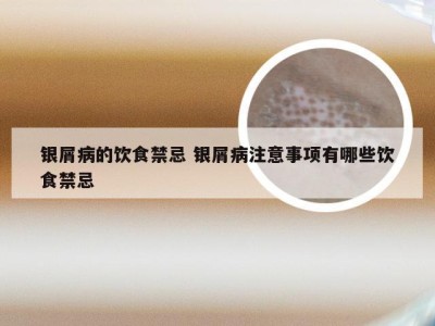 银屑病的饮食禁忌 银屑病注意事项有哪些饮食禁忌