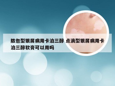 脓包型银屑病用卡泊三醇 点滴型银屑病用卡泊三醇软膏可以用吗