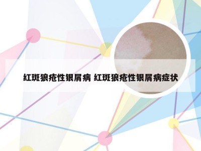 红斑狼疮性银屑病 红斑狼疮性银屑病症状