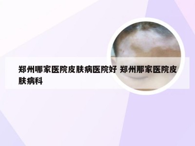 郑州哪家医院皮肤病医院好 郑州那家医院皮肤病科