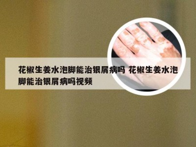 花椒生姜水泡脚能治银屑病吗 花椒生姜水泡脚能治银屑病吗视频