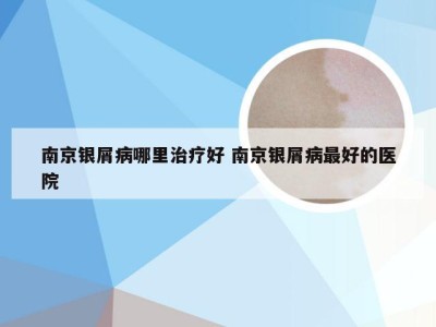 南京银屑病哪里治疗好 南京银屑病最好的医院
