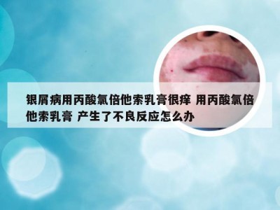银屑病用丙酸氯倍他索乳膏很痒 用丙酸氯倍他索乳膏 产生了不良反应怎么办
