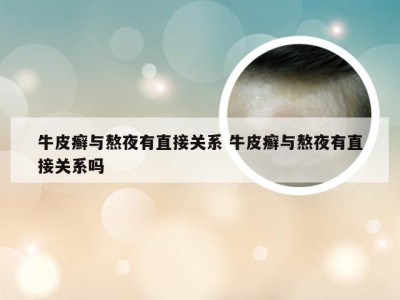 牛皮癣与熬夜有直接关系 牛皮癣与熬夜有直接关系吗