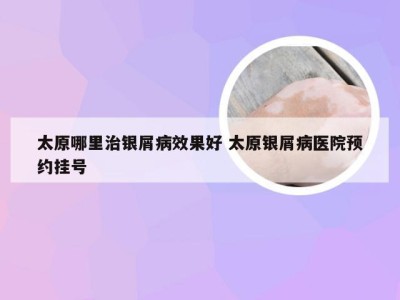 太原哪里治银屑病效果好 太原银屑病医院预约挂号