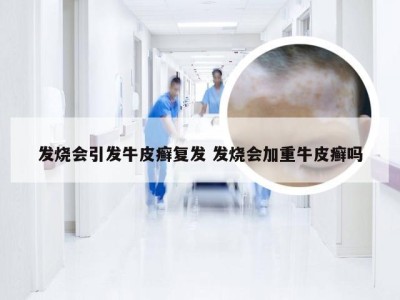 发烧会引发牛皮癣复发 发烧会加重牛皮癣吗