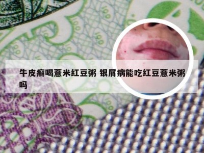 牛皮癣喝薏米红豆粥 银屑病能吃红豆薏米粥吗