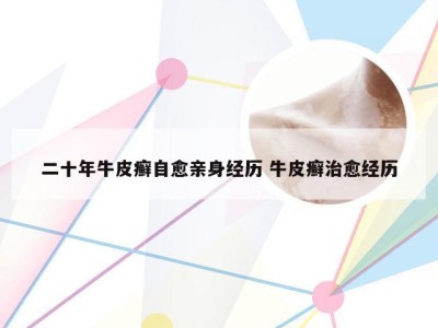 二十年牛皮癣自愈亲身经历 牛皮癣治愈经历