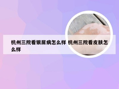 杭州三院看银屑病怎么样 杭州三院看皮肤怎么样