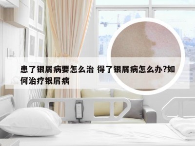 患了银屑病要怎么治 得了银屑病怎么办?如何治疗银屑病