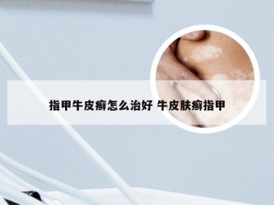 指甲牛皮癣怎么治好 牛皮肤癣指甲