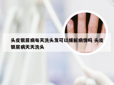 头皮银屑病每天洗头发可以缓解病情吗 头皮银屑病天天洗头