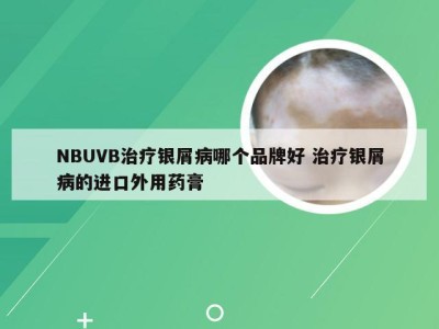 NBUVB治疗银屑病哪个品牌好 治疗银屑病的进口外用药膏