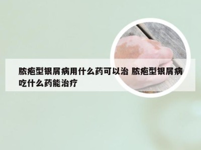 脓疱型银屑病用什么药可以治 脓疱型银屑病吃什么药能治疗