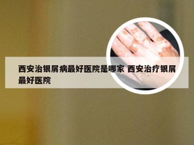 西安治银屑病最好医院是哪家 西安治疗银屑最好医院