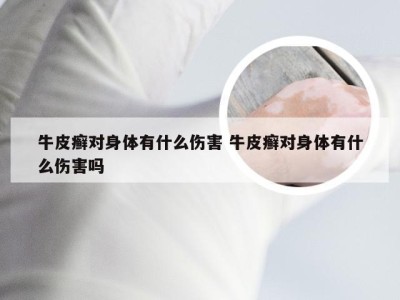 牛皮癣对身体有什么伤害 牛皮癣对身体有什么伤害吗