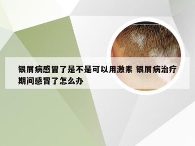 银屑病感冒了是不是可以用激素 银屑病治疗期间感冒了怎么办