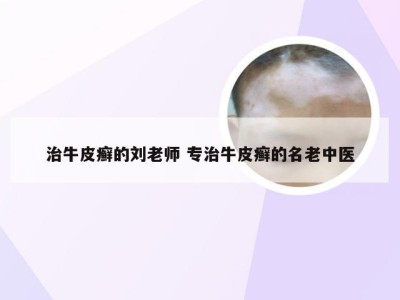 治牛皮癣的刘老师 专治牛皮癣的名老中医