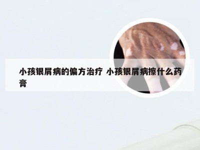 小孩银屑病的偏方治疗 小孩银屑病擦什么药膏