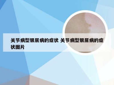 关节病型银屑病的症状 关节病型银屑病的症状图片