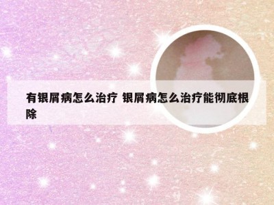 有银屑病怎么治疗 银屑病怎么治疗能彻底根除