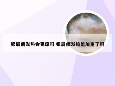 银屑病发热会更痒吗 银屑病发热是加重了吗