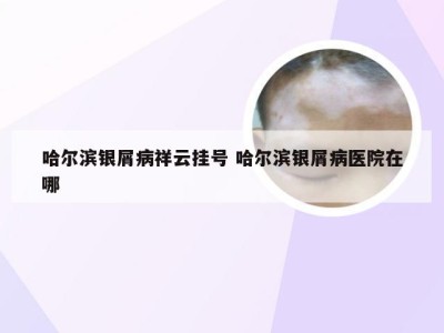 哈尔滨银屑病祥云挂号 哈尔滨银屑病医院在哪