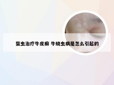 蝥虫治疗牛皮癣 牛蛲虫病是怎么引起的