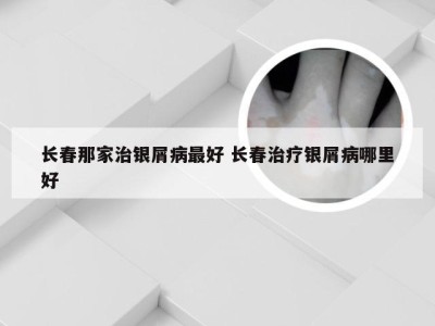 长春那家治银屑病最好 长春治疗银屑病哪里好
