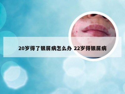20岁得了银屑病怎么办 22岁得银屑病
