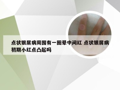 点状银屑病周围有一圈晕中间红 点状银屑病初期小红点凸起吗