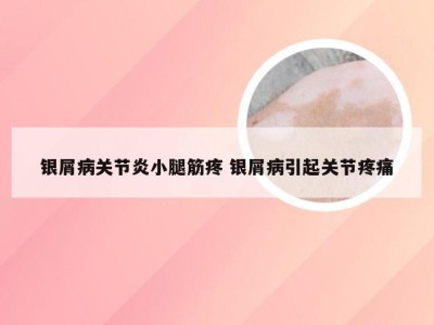 银屑病关节炎小腿筋疼 银屑病引起关节疼痛