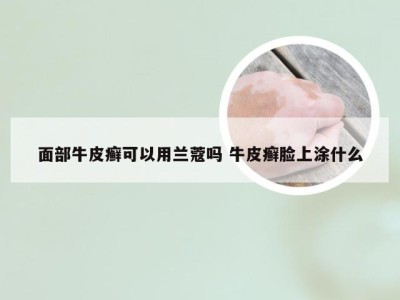 面部牛皮癣可以用兰蔻吗 牛皮癣脸上涂什么