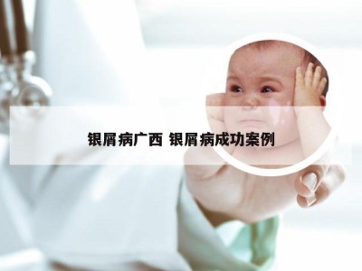 银屑病广西 银屑病成功案例