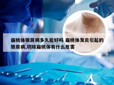扁桃体银屑病多久能好吗 扁桃体发炎引起的银屑病,切除扁桃体有什么危害