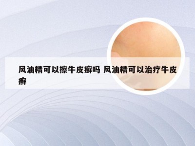 风油精可以擦牛皮癣吗 风油精可以治疗牛皮癣