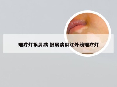 理疗灯银屑病 银屑病用红外线理疗灯