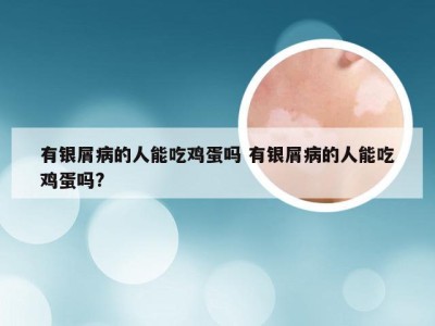 有银屑病的人能吃鸡蛋吗 有银屑病的人能吃鸡蛋吗?