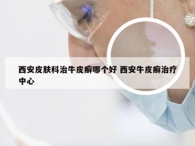 西安皮肤科治牛皮癣哪个好 西安牛皮癣治疗中心