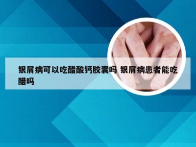 银屑病可以吃醋酸钙胶囊吗 银屑病患者能吃醋吗