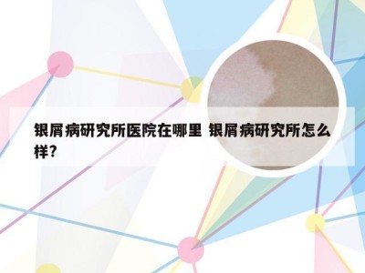 银屑病研究所医院在哪里 银屑病研究所怎么样?